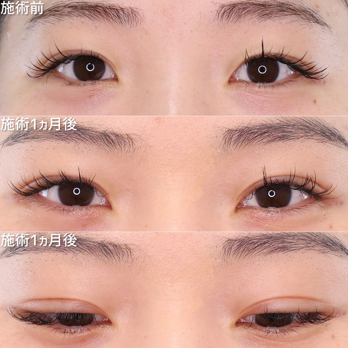 二重埋没法の症例写真 施術前後 １ヵ月