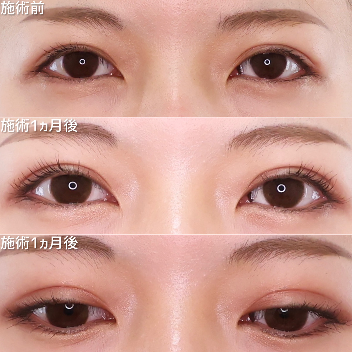 二重埋没法の症例写真 施術前後 1ヵ月