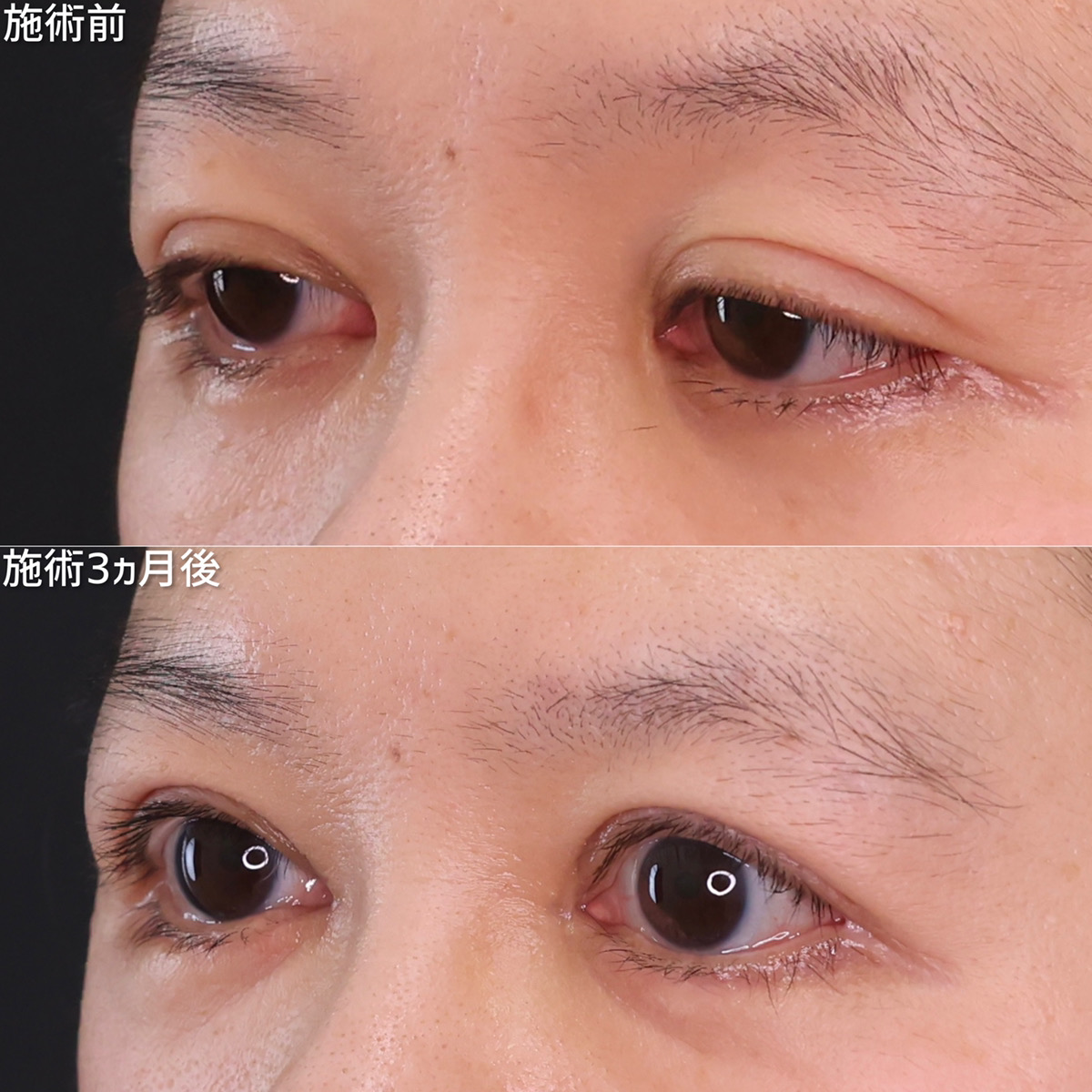 目頭切開術/上眼瞼切開術/下眼瞼切開術（クマ・たるみとり）の症例写真 施術前後 3ヵ月