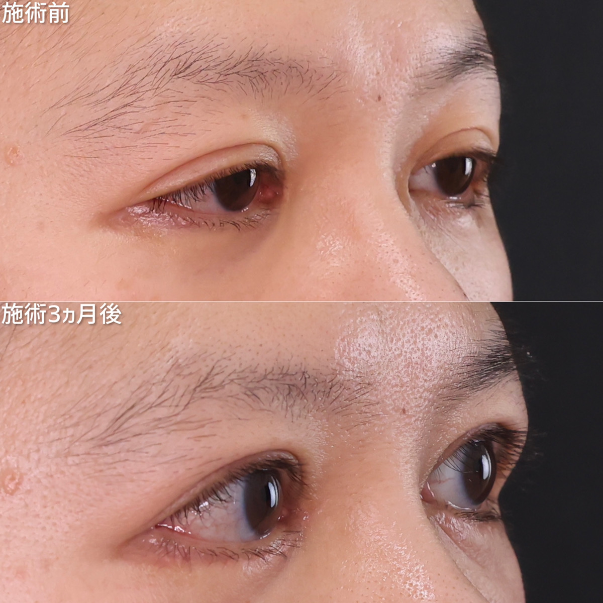 目頭切開術/上眼瞼切開術/下眼瞼切開術（クマ・たるみとり）の症例写真 施術前後 3ヵ月