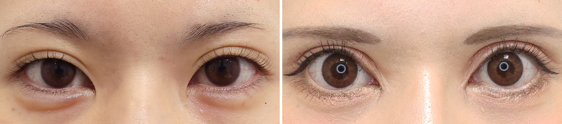 二重切開（全切開法）/目頭切開術/眼瞼下垂（目つき矯正）の症例写真 施術前後 1ヵ月