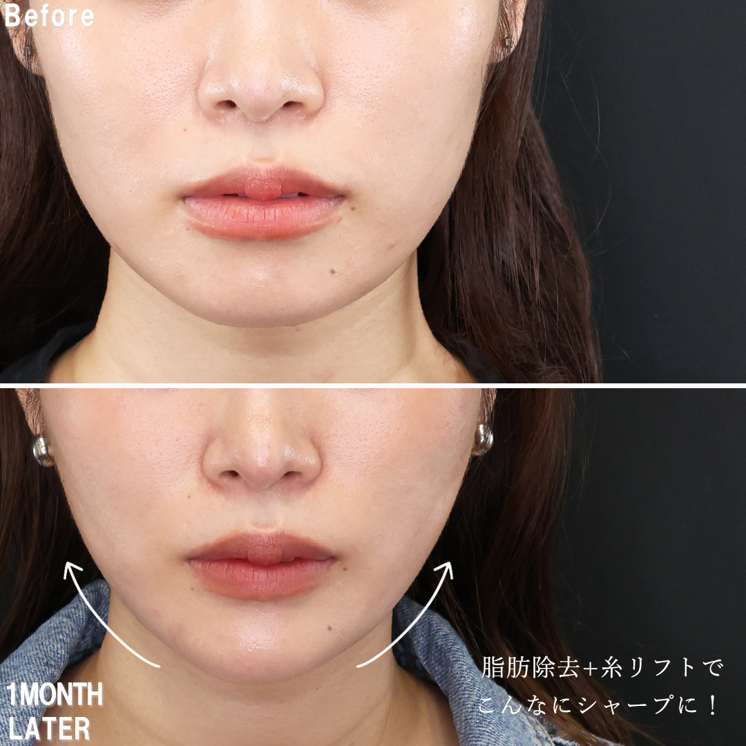 TAC式 ツヤ肌コラーゲンリフト®/エラボトックス注射/顎のヒアルロン酸注射の症例写真 施術前後