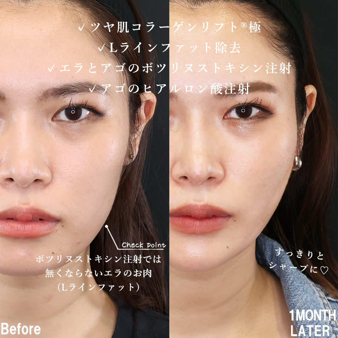 TAC式 ツヤ肌コラーゲンリフト®/エラボトックス注射/顎のヒアルロン酸注射の症例写真 施術前後