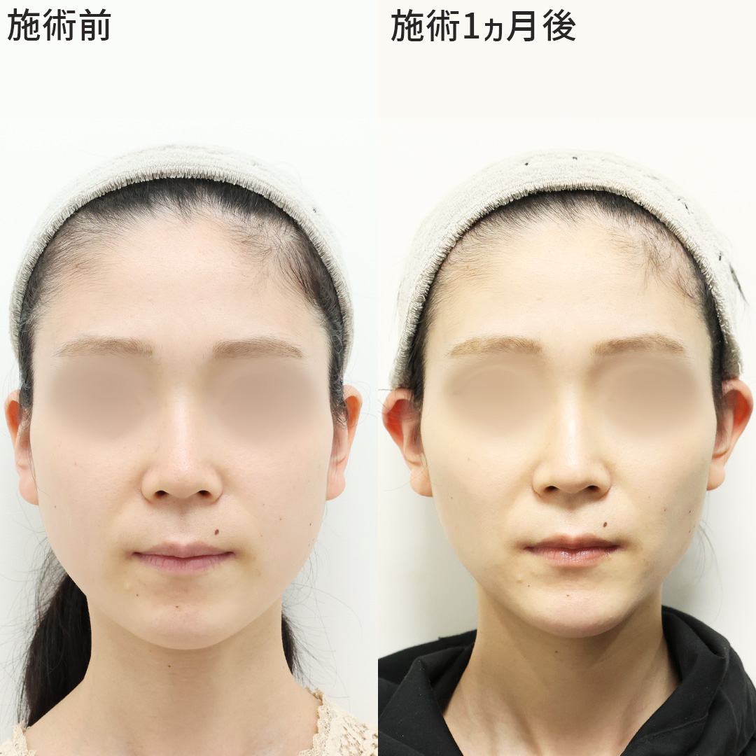 古川医師の小顔セット施術