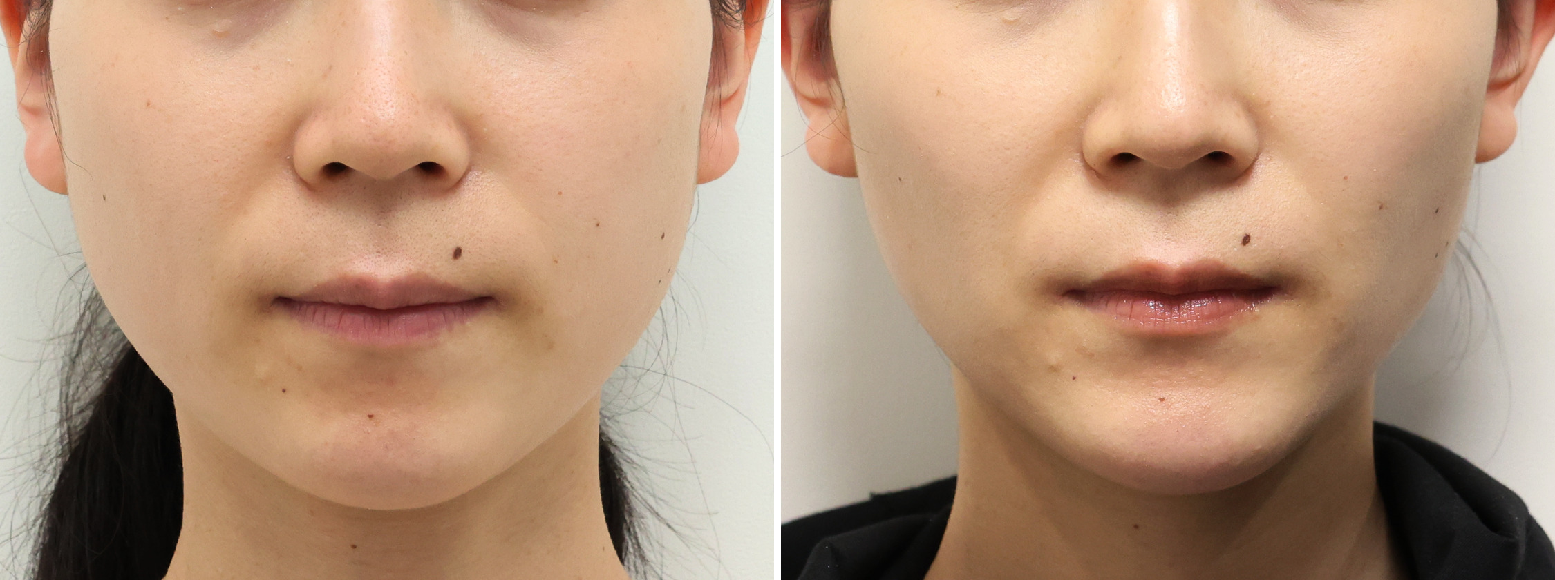 小顔整形｜パーフェクトフェイスラインの症例写真 施術前後 1ヵ月