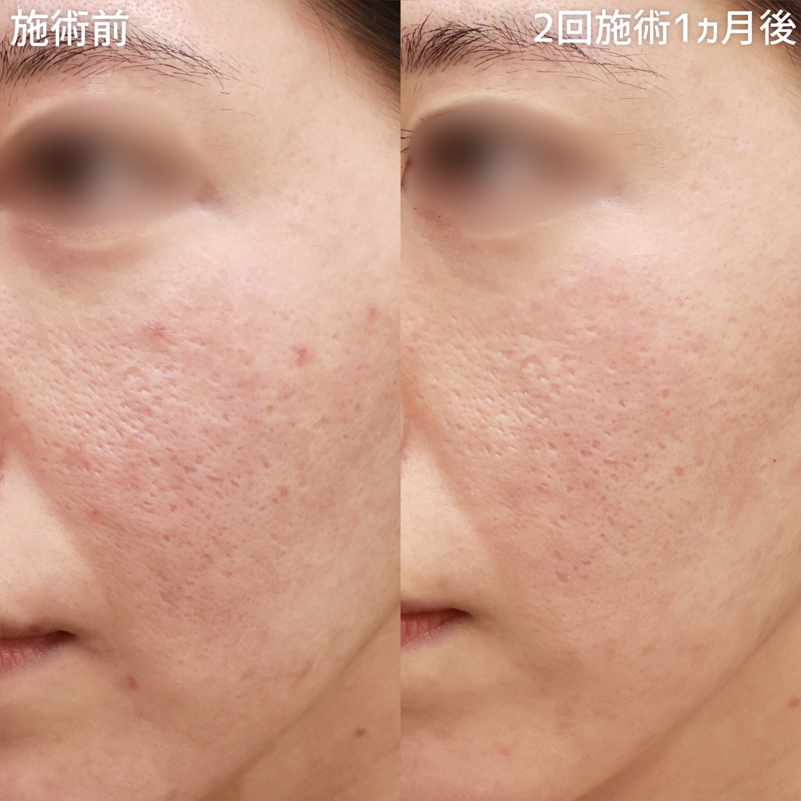 ダーマペン4/エクソソーム/ベルベットスキンの症例写真 施術前後 １ヵ月