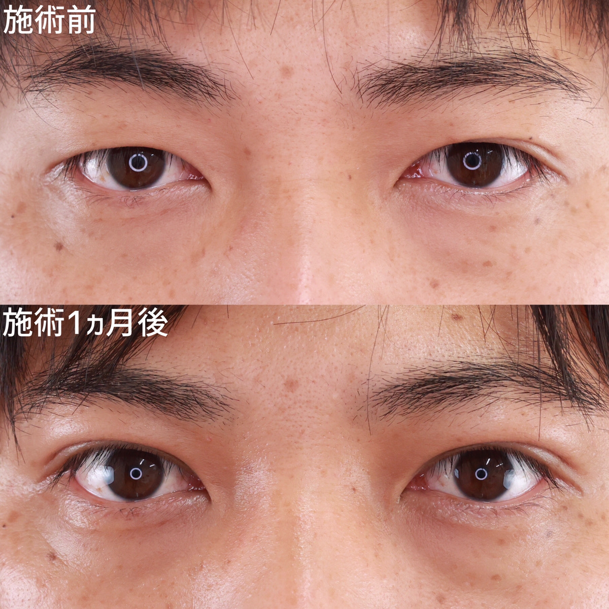 【二重埋没法】自然な変化で凛々しい目元をGET