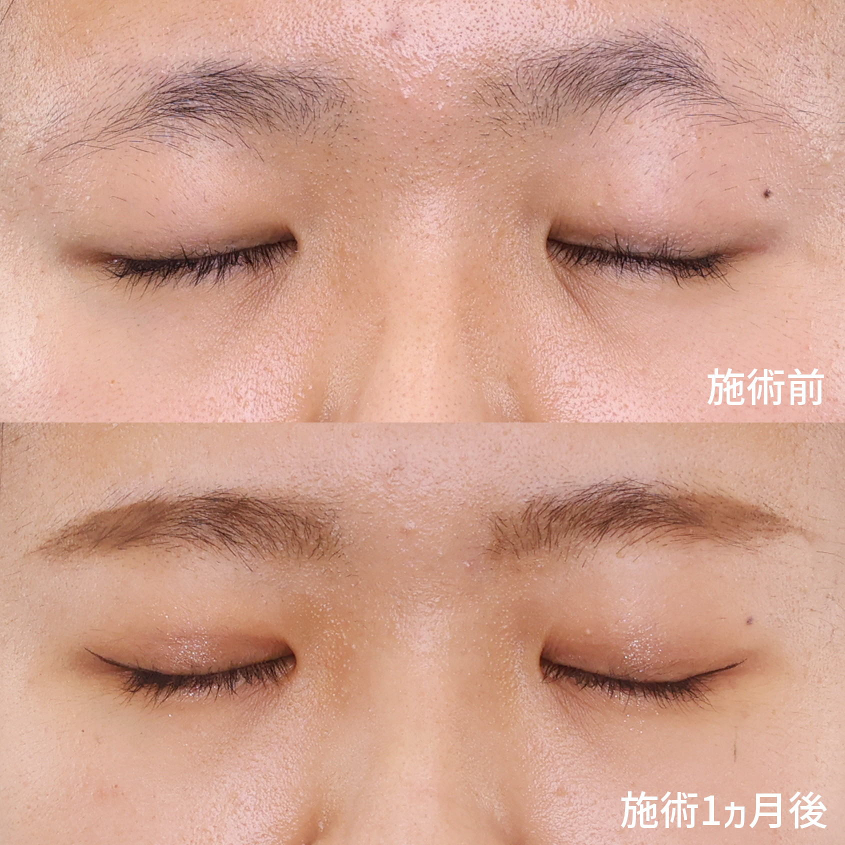 の症例写真 施術前後 １ヵ月