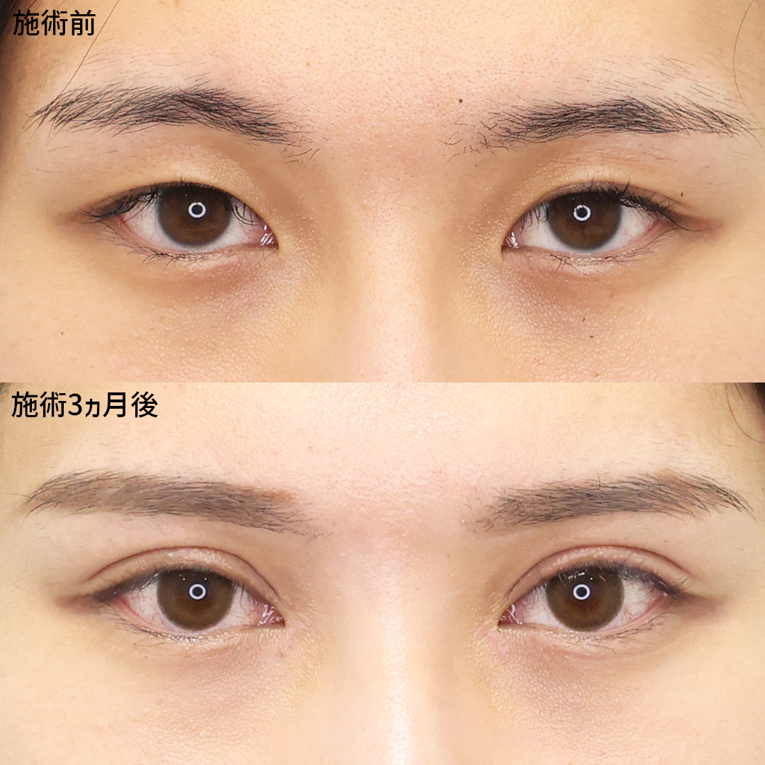 目頭切開術/二重切開（全切開法）/口角挙上・リフト（マイクロ切開法・内側法/口内法）の症例写真 施術前後 