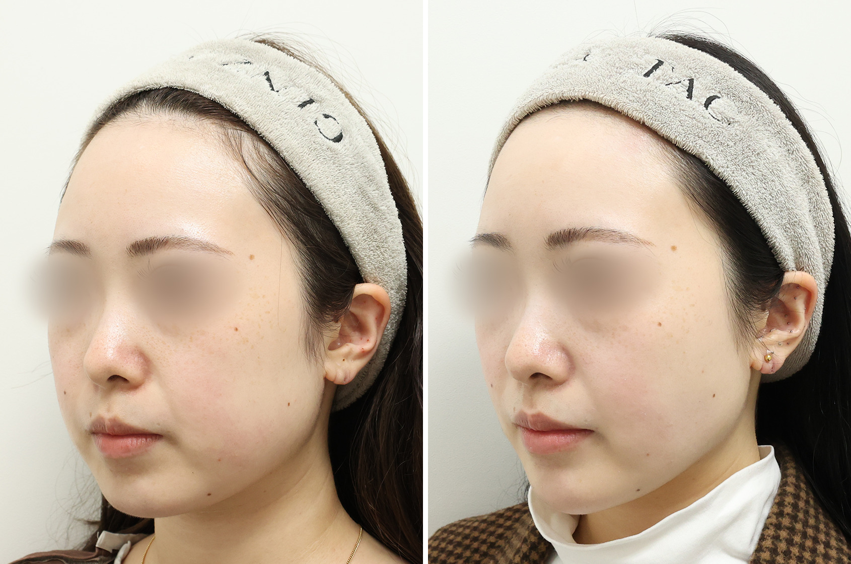 小顔整形｜パーフェクトフェイスラインの症例写真 施術前後 2ヵ月