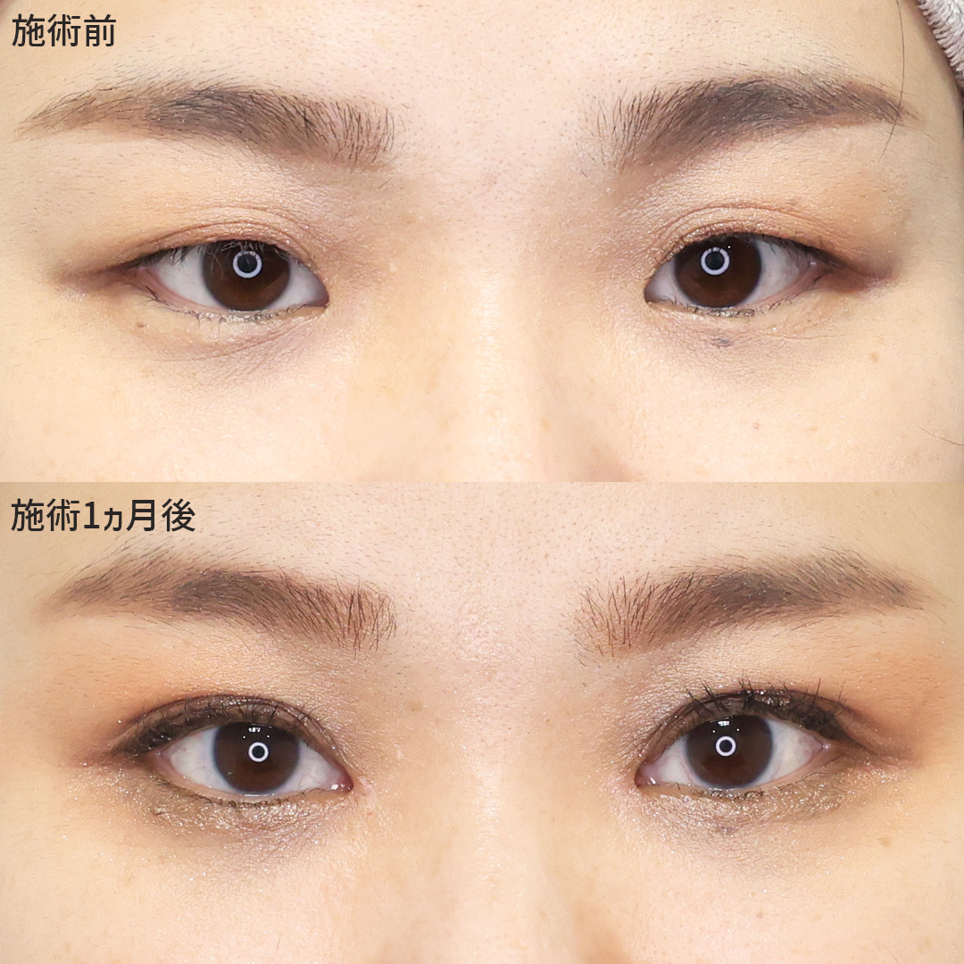 【埋没法×目頭切開術】ナチュラルに大人可愛い目元へ