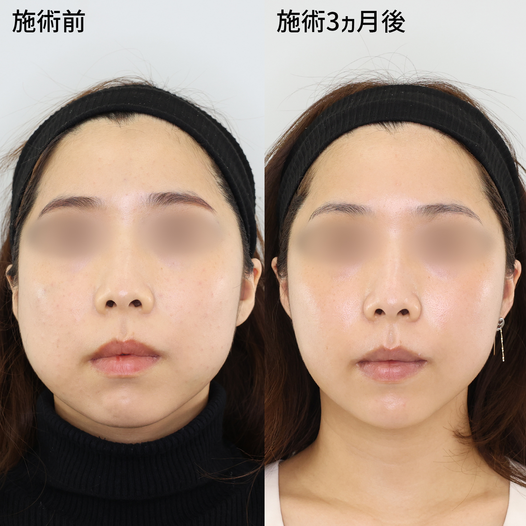 どの角度から見ても美しいスッキリ小顔に！【パーフェクトフェイスライン】