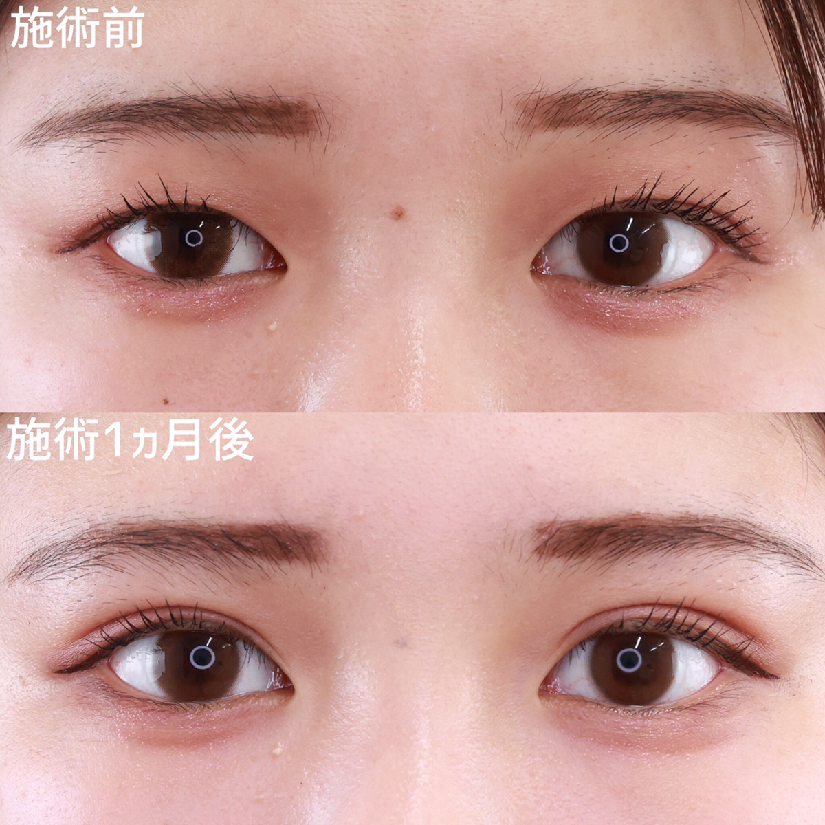 大人の雰囲気溢れる二重【二重埋没法】