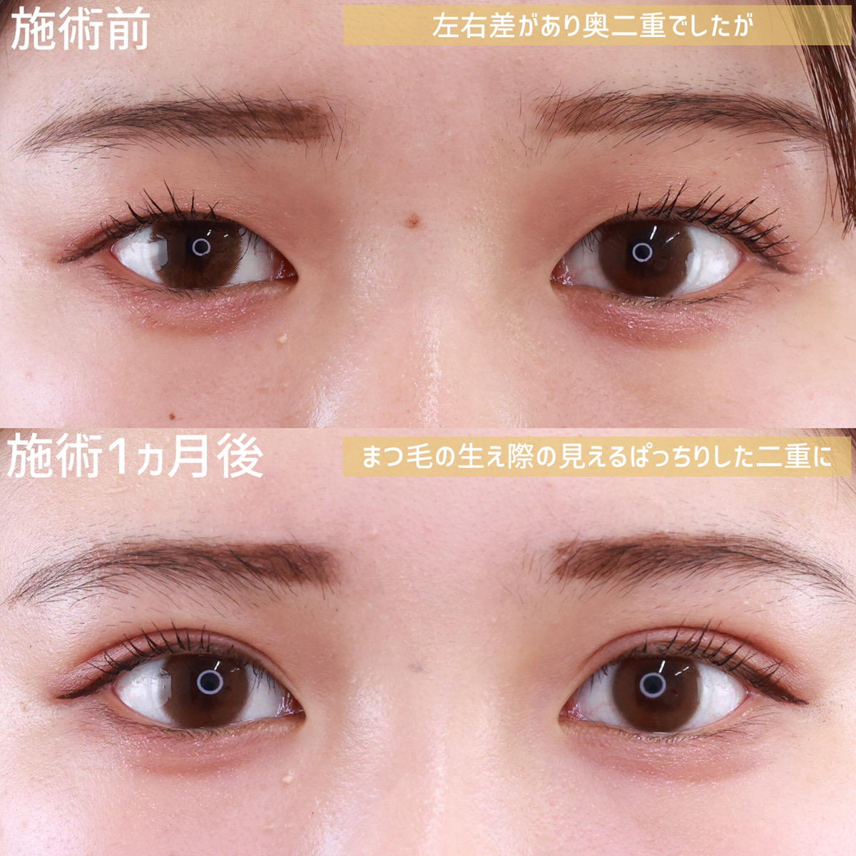 二重埋没法/目元：その他の症例写真 施術前後 