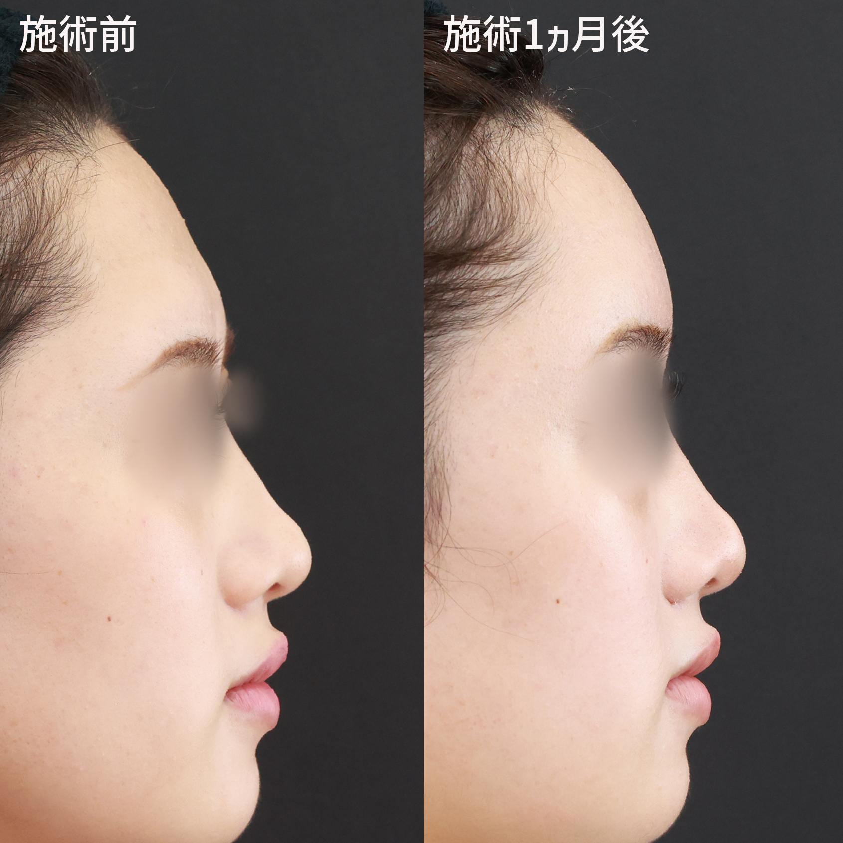 おでこの脂肪注入（オルチャンデコ形成）の症例写真 施術前後 １ヵ月