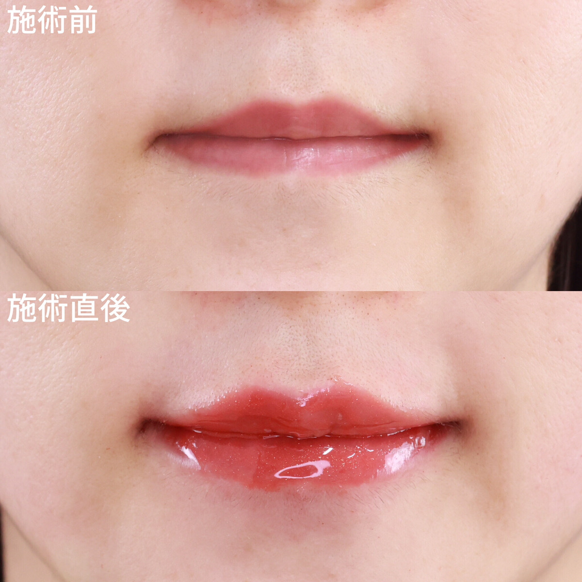 【唇のヒアルロン酸】バランスの取れたセクシーリップ