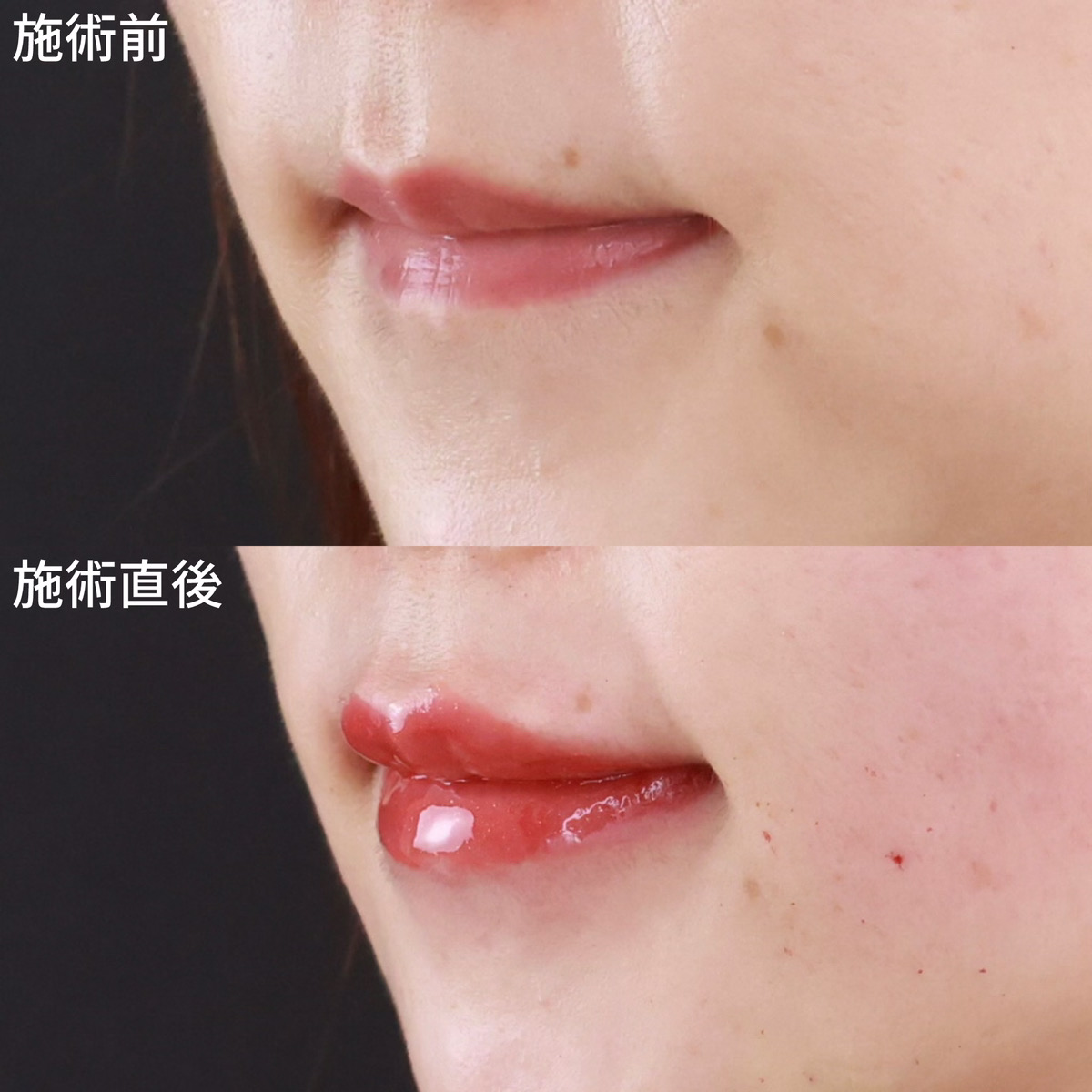 ヒアルロン酸注射：その他の症例写真 施術前後 