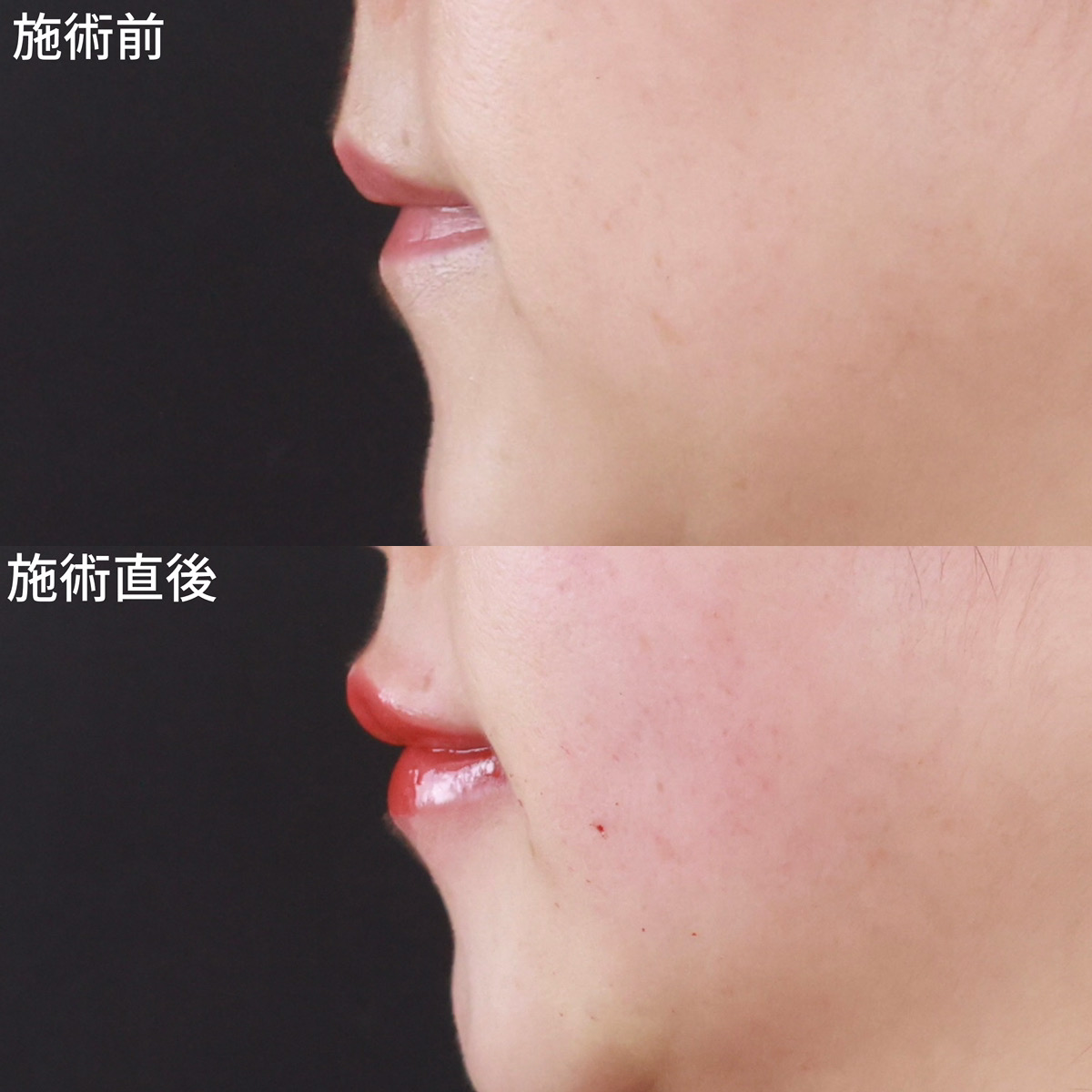 ヒアルロン酸注射：その他の症例写真 施術前後 