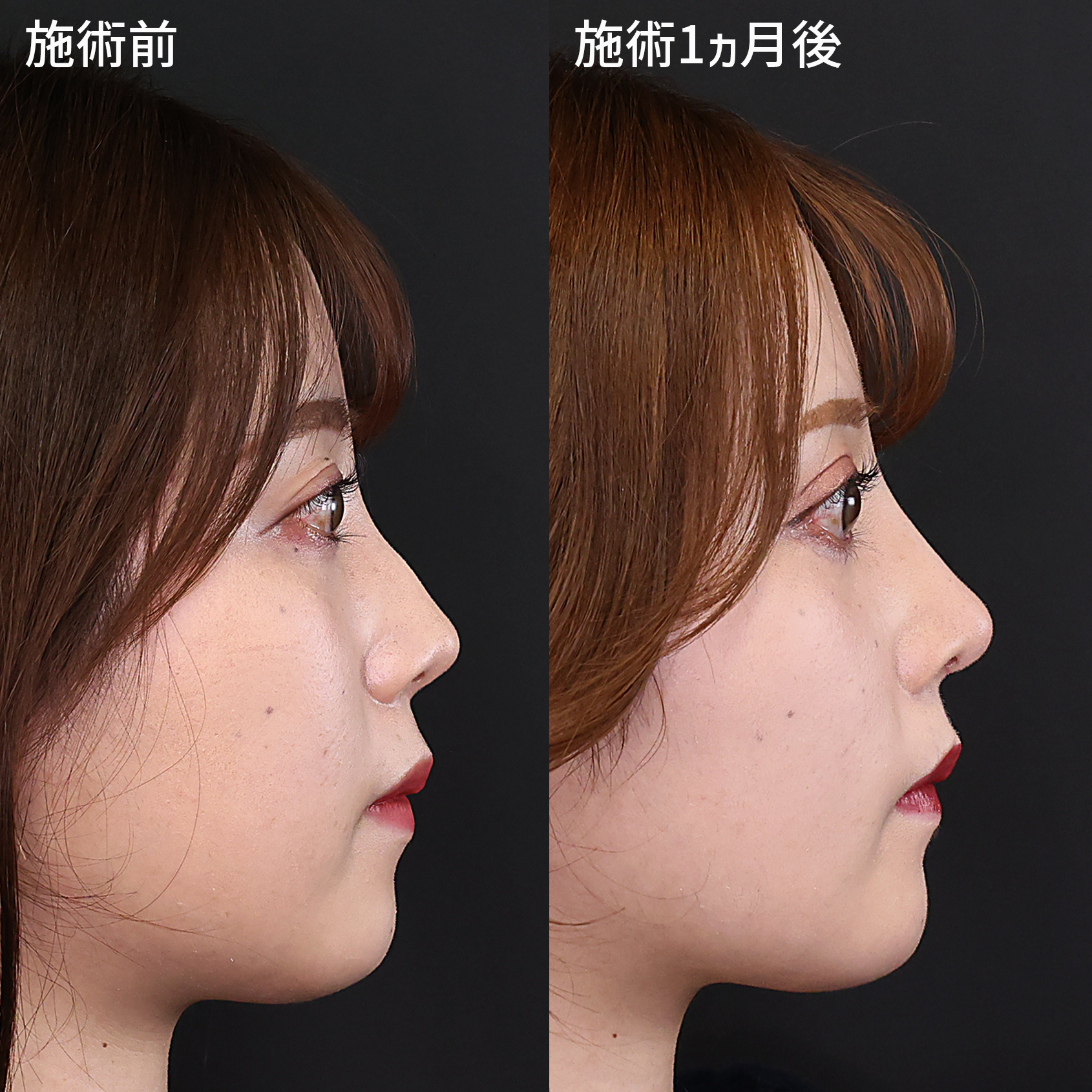 鼻中隔延長術/鼻尖形成・鼻尖縮小/隆鼻術（プロテーゼ・自家組織）の症例写真 施術前後 １ヵ月