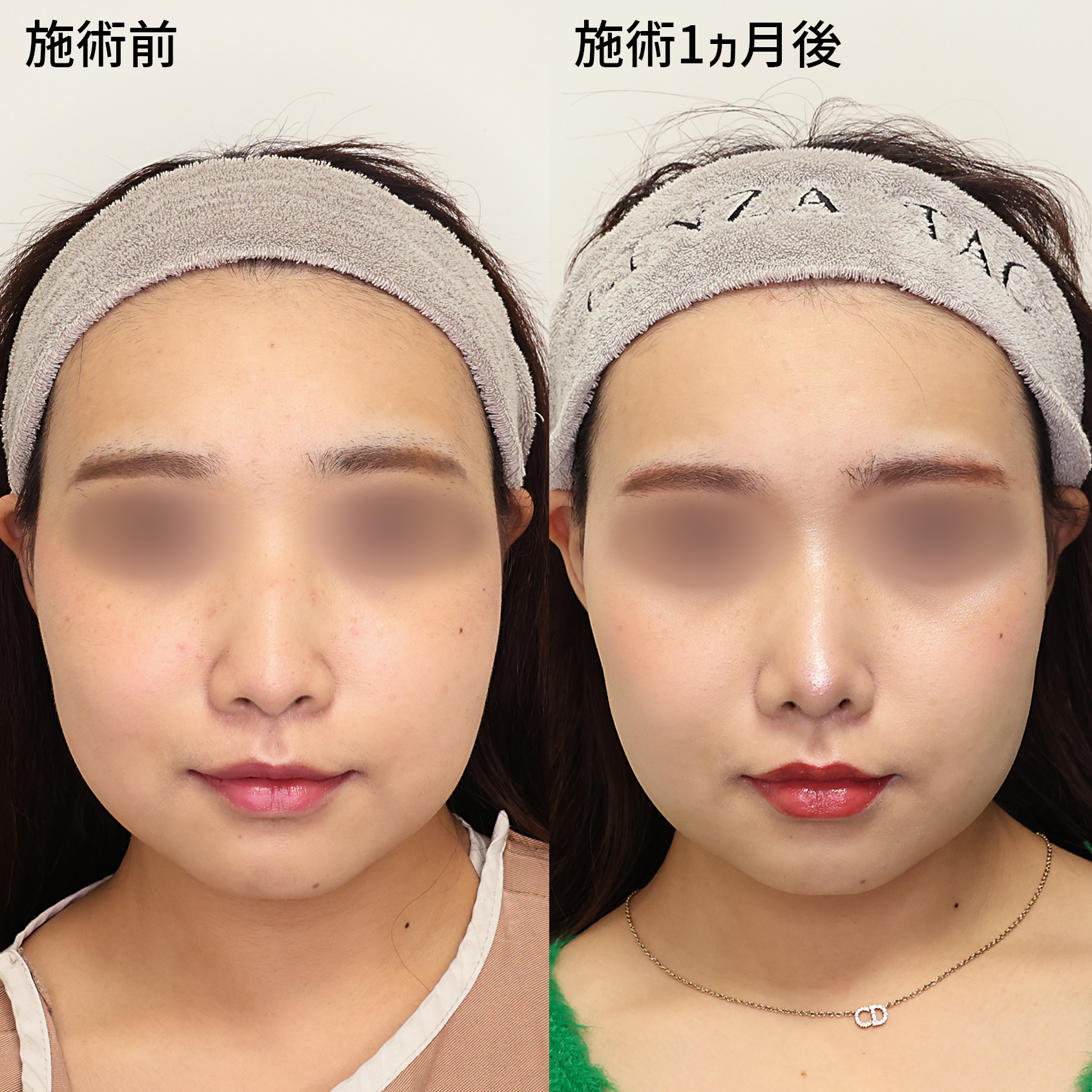 長年のお悩みをスッキリ改善！！バランスのとれたお顔のポイントはお鼻のかたち。