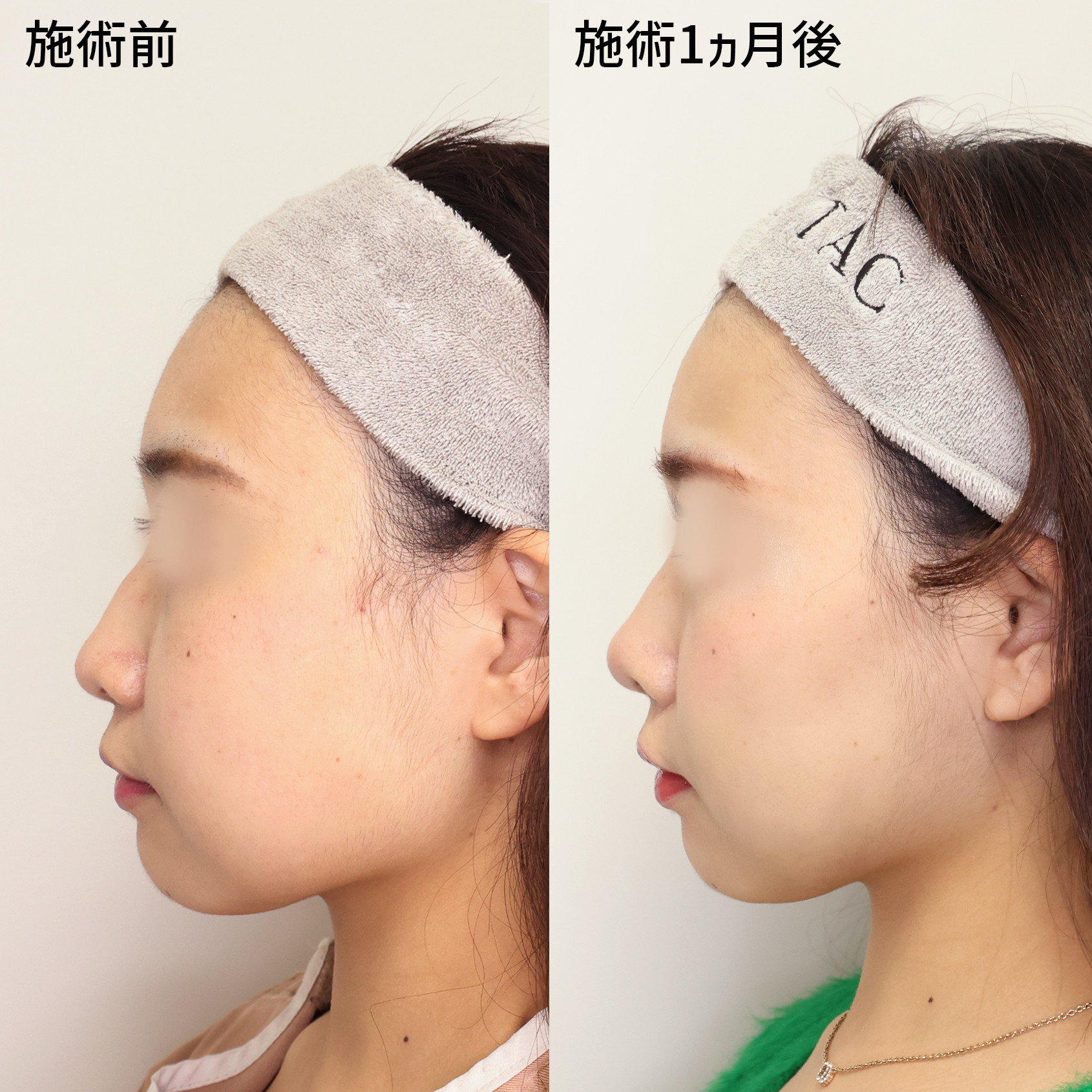 鼻中隔延長術/鼻尖形成・鼻尖縮小/鼻先軟骨移植の症例写真 施術前後 １ヵ月