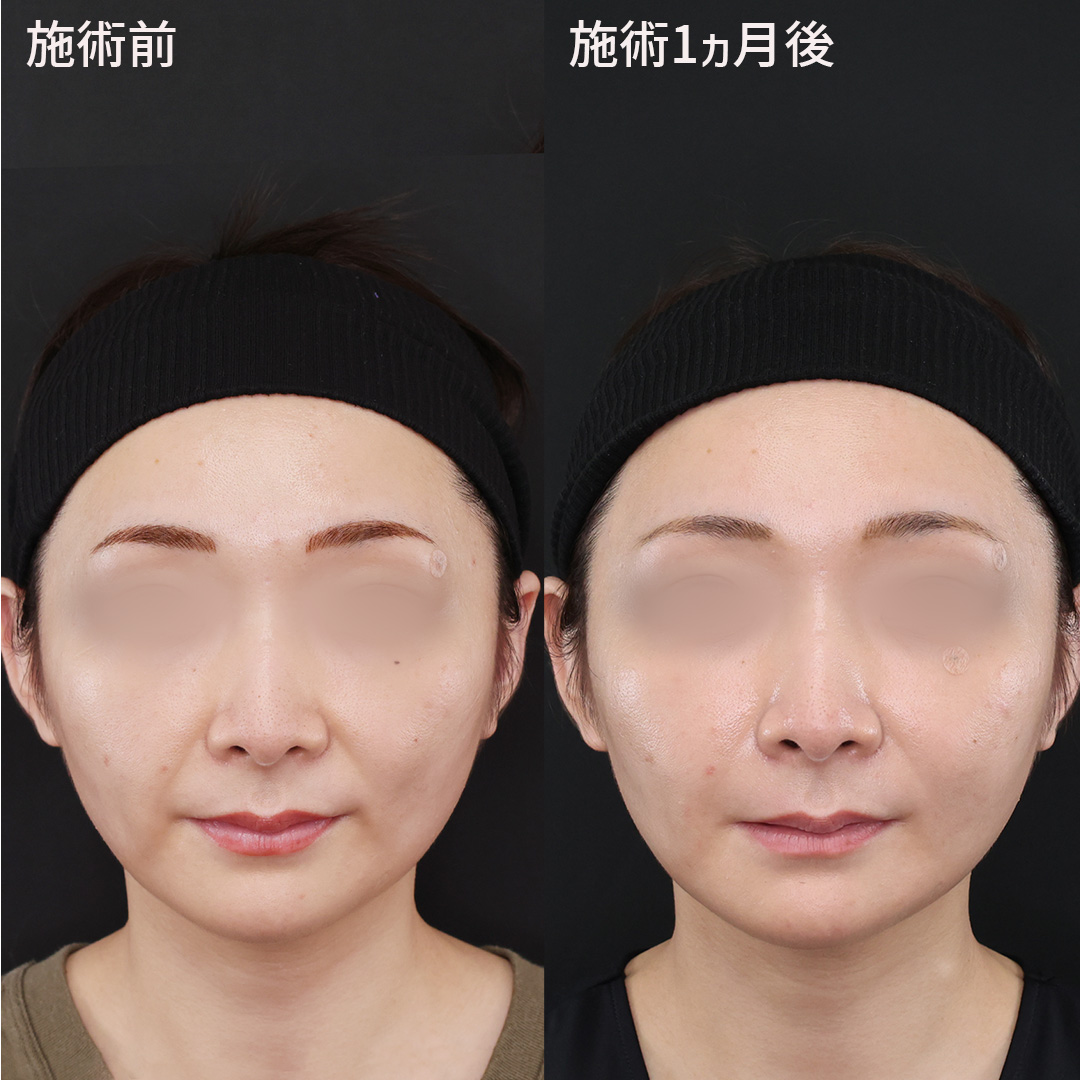 【30代のほうれい線】ご自身の脂肪で解消