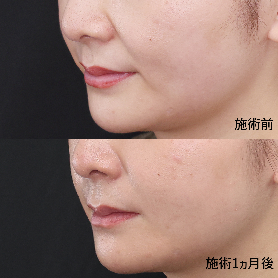 顔の脂肪注入(コンデンスリッチフェイス)/TAC式 ショッピングリフトの症例写真 施術前後 
