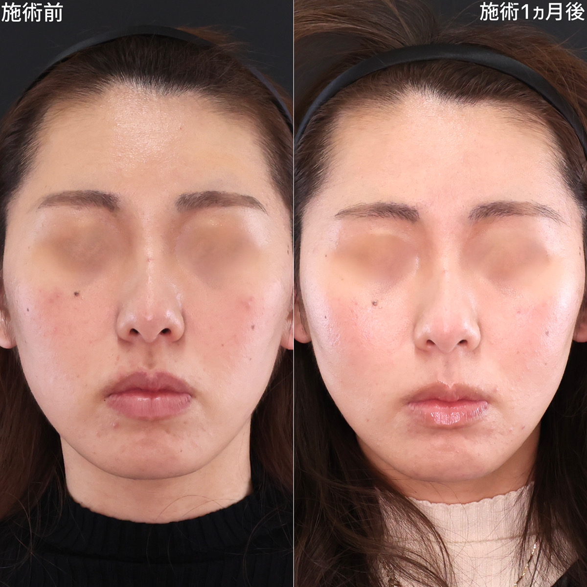 自然だけどしっかり変化！憧れの卵型フェイス