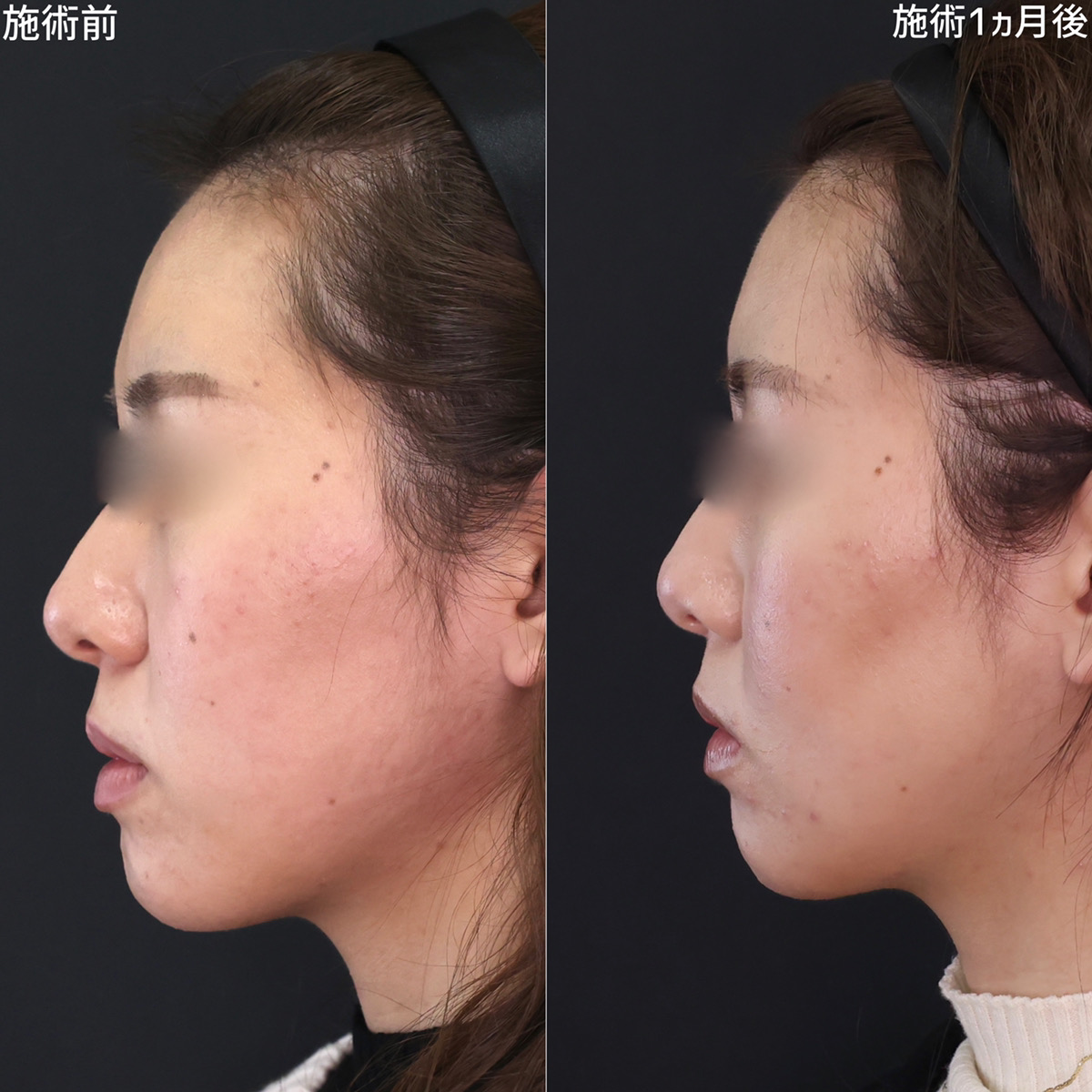 TAC式 ツヤ肌コラーゲンリフト®の症例写真 施術前後 