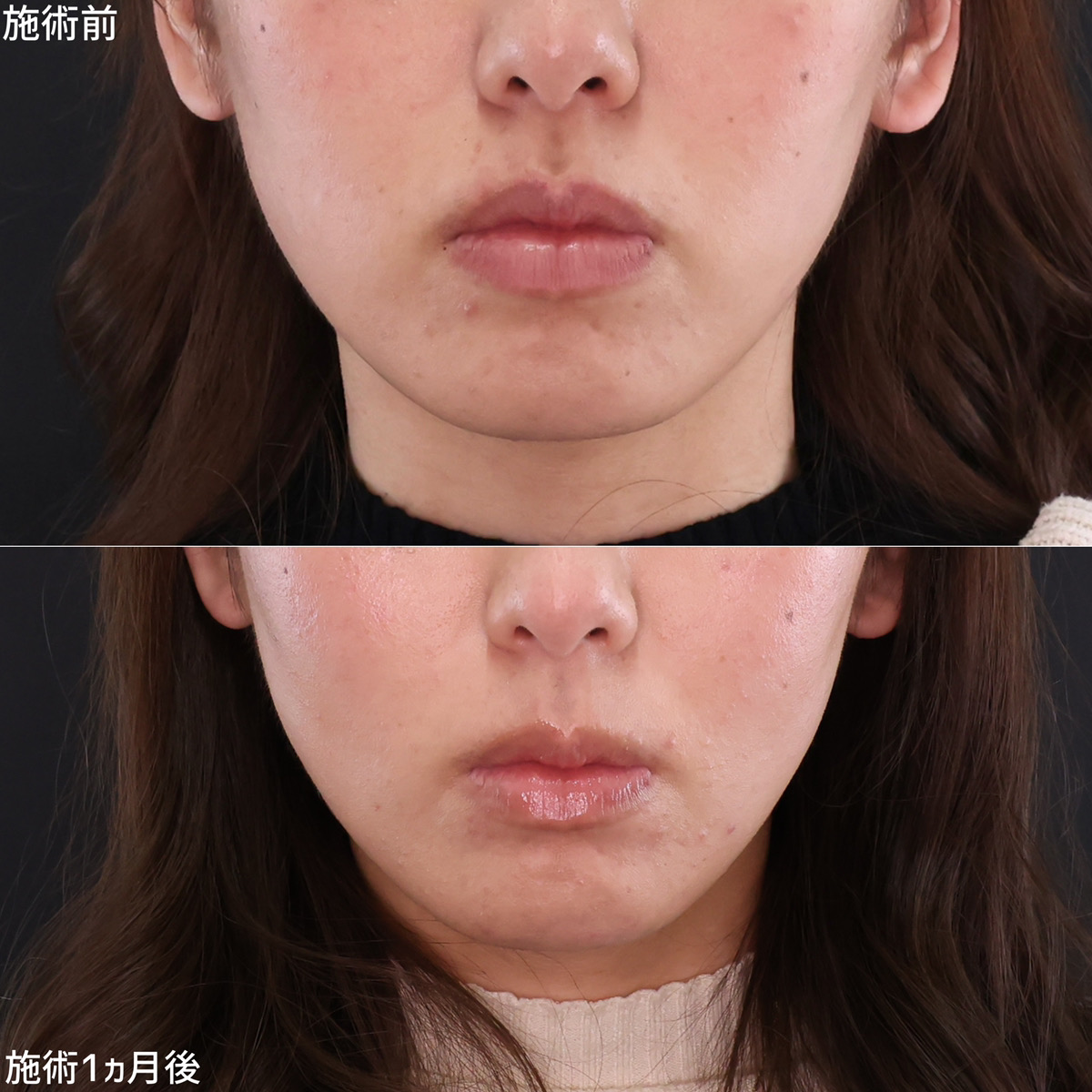 TAC式 ツヤ肌コラーゲンリフト®の症例写真 施術前後 