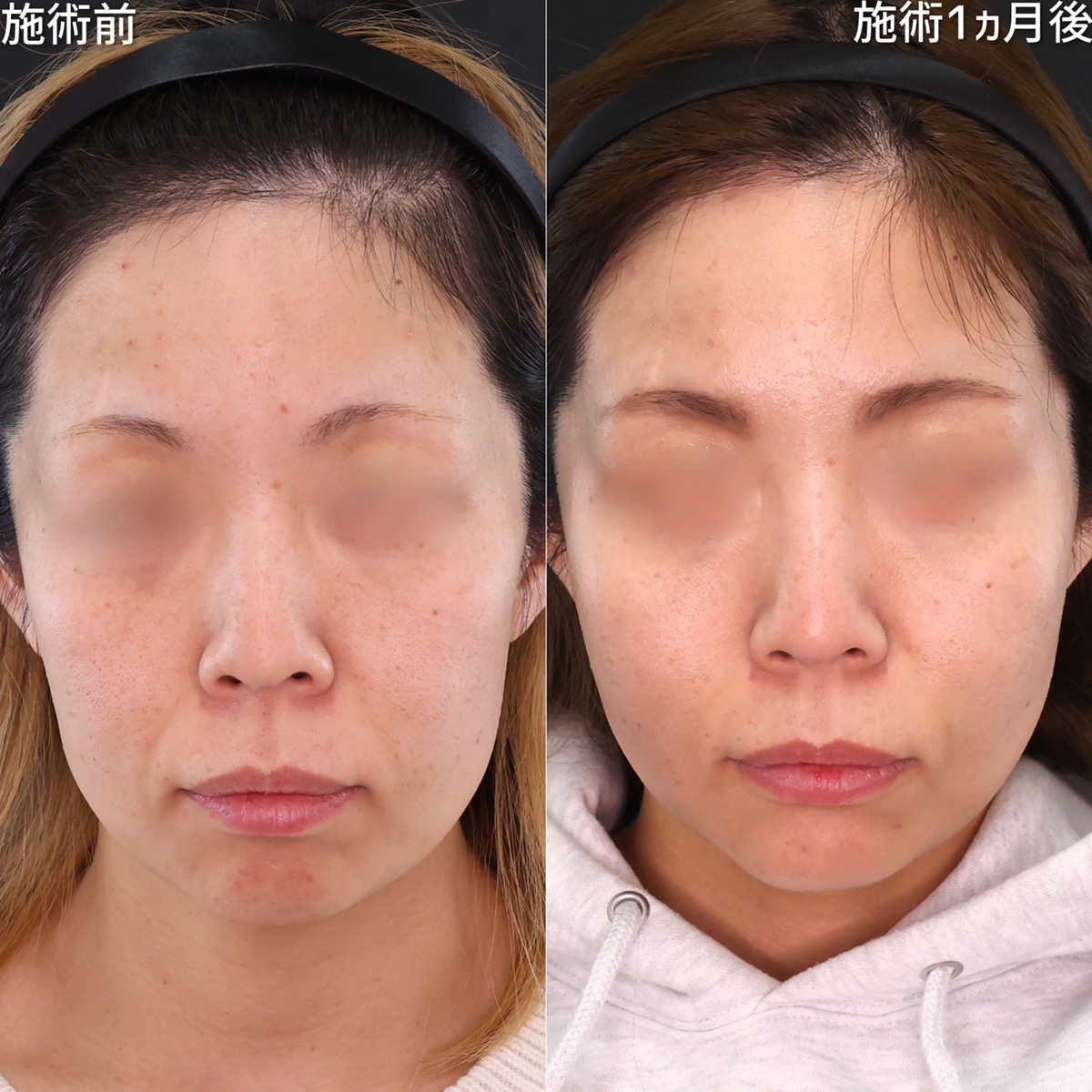 頬のもたつきを改善し若返り効果！