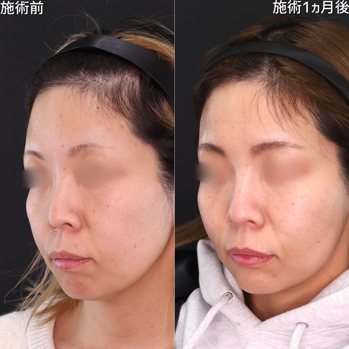 TAC式 ツヤ肌コラーゲンリフト®/ジョールファット除去/顎のヒアルロン酸注射の症例写真 施術前後 1ヵ月