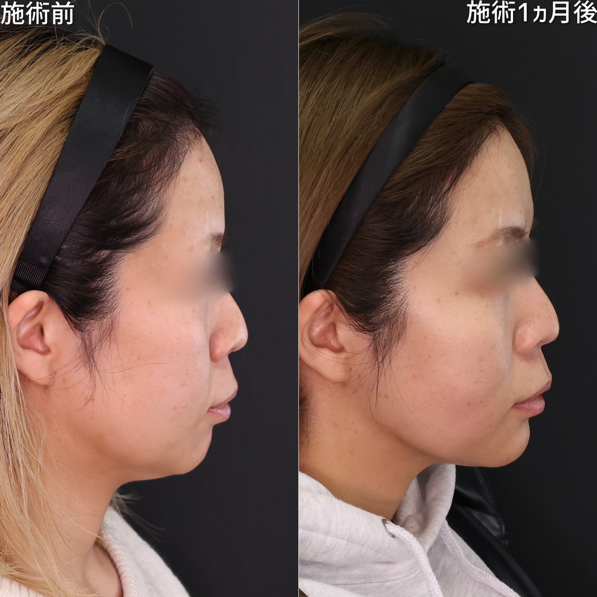 TAC式 ツヤ肌コラーゲンリフト®/ジョールファット除去/顎のヒアルロン酸注射の症例写真 施術前後 1ヵ月