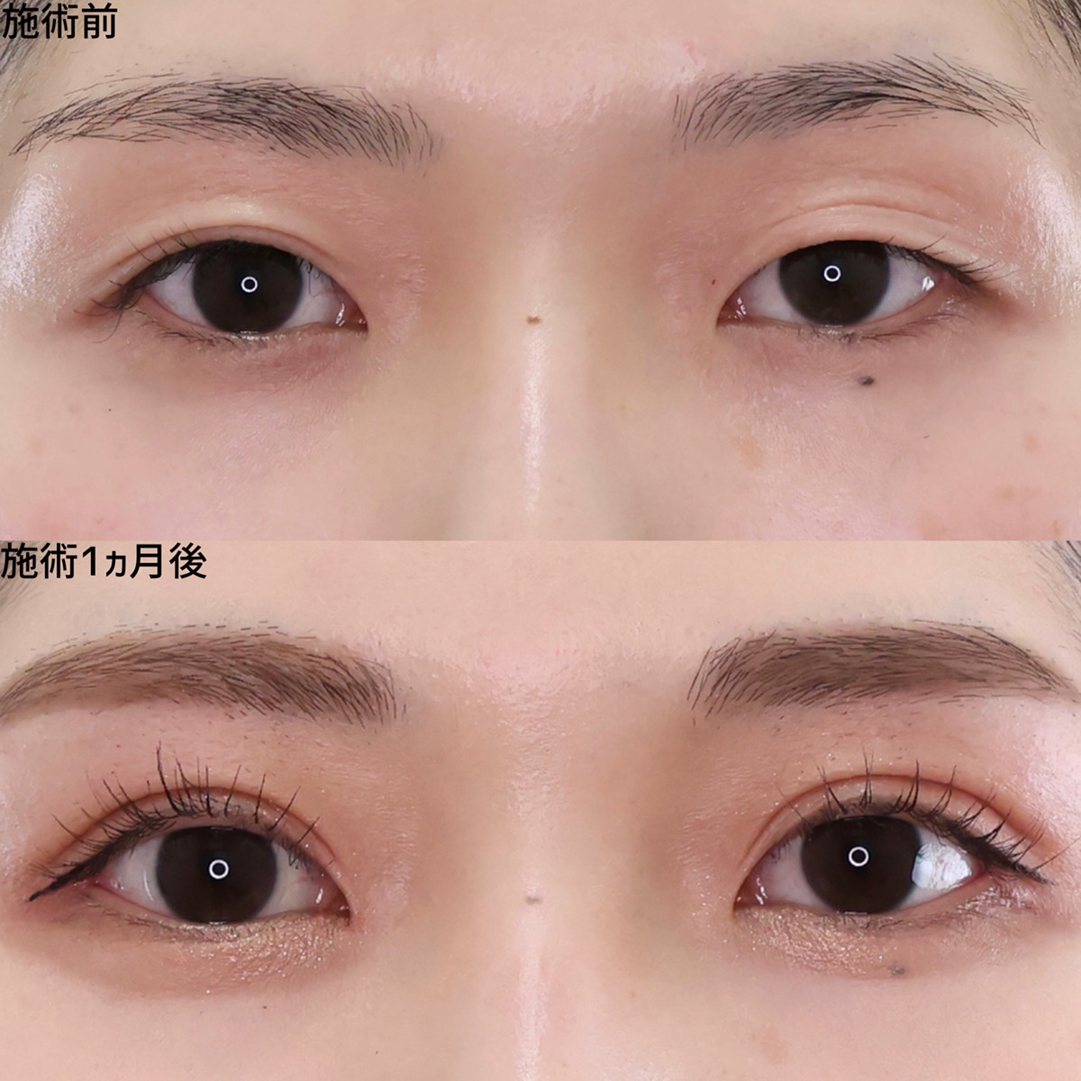 二重埋没法/目尻切開術の症例写真 施術前後 