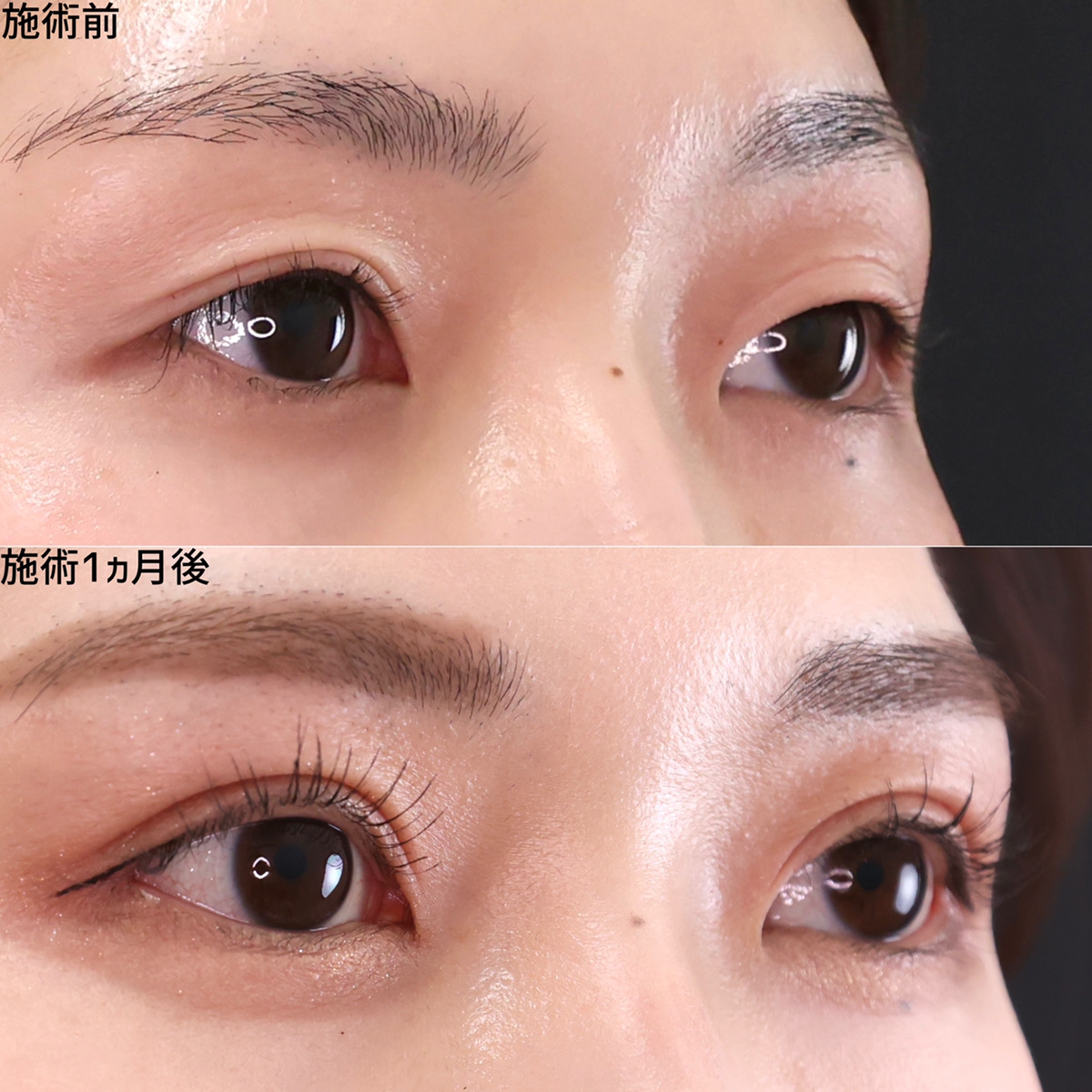 目尻切開を組み合わせて別人級ぱっちり二重