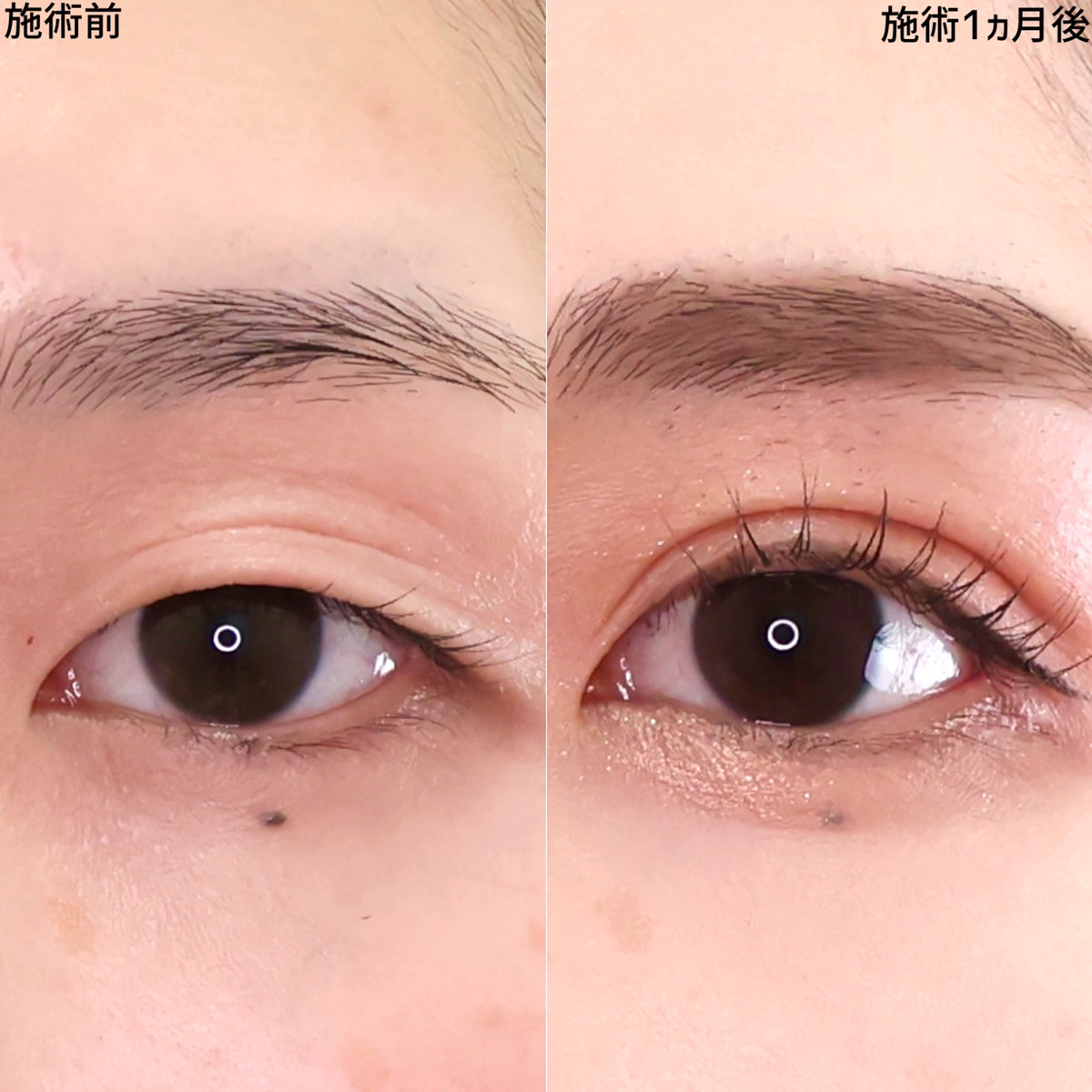 二重埋没法/目尻切開術の症例写真 施術前後 