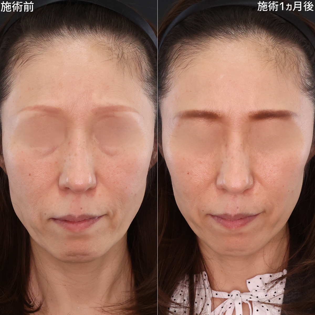 TAC式 ツヤ肌コラーゲンリフト®の症例写真 施術前後 1ヵ月