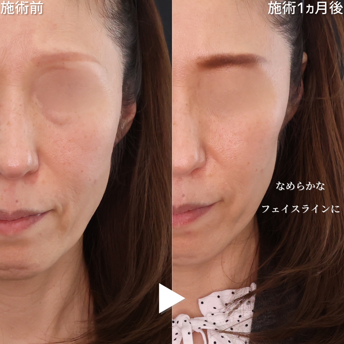 TAC式 ツヤ肌コラーゲンリフト®の症例写真 施術前後 1ヵ月