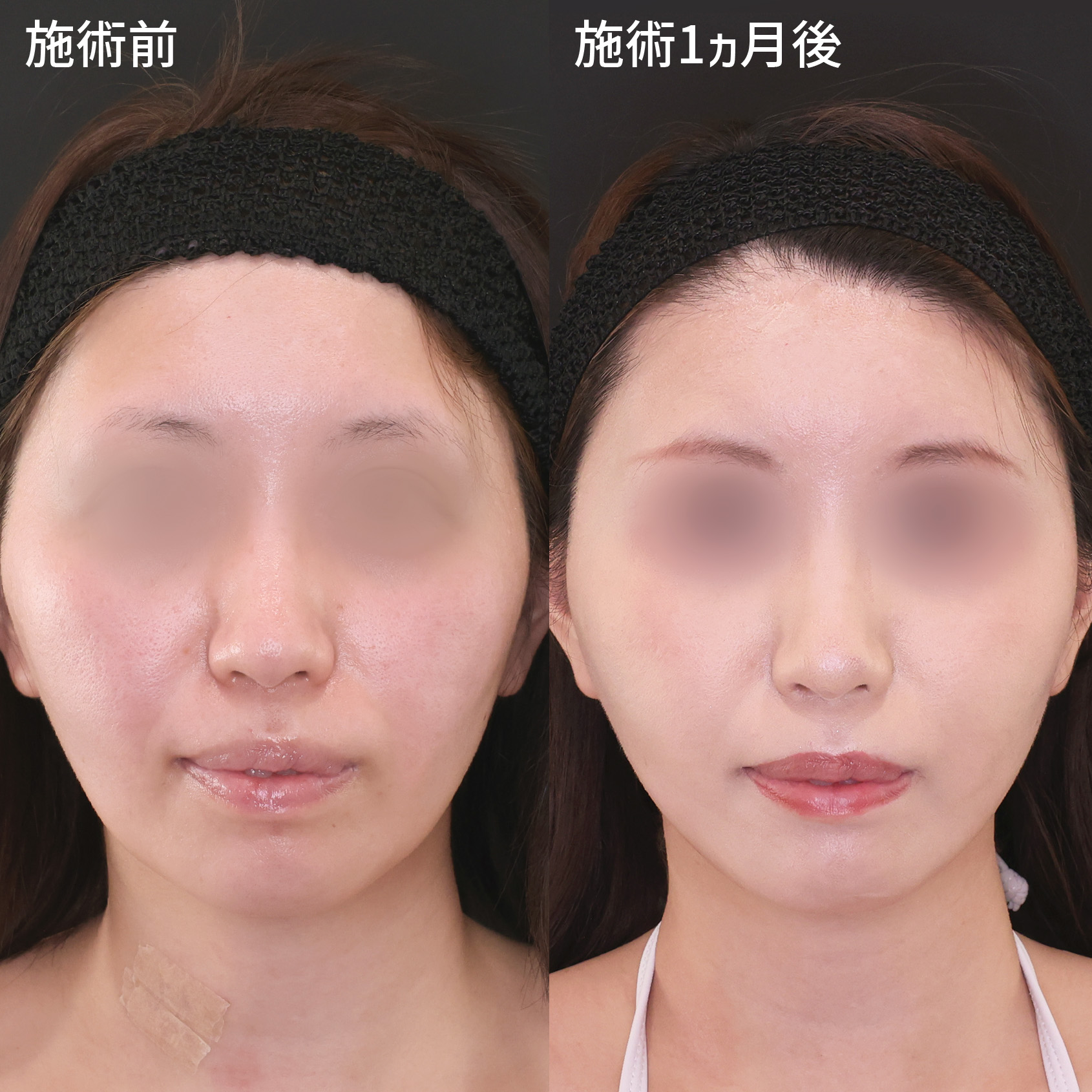 顔の脂肪注入(コンデンスリッチフェイス)/TAC式 ツヤ肌コラーゲンリフト®の症例写真 施術前後 