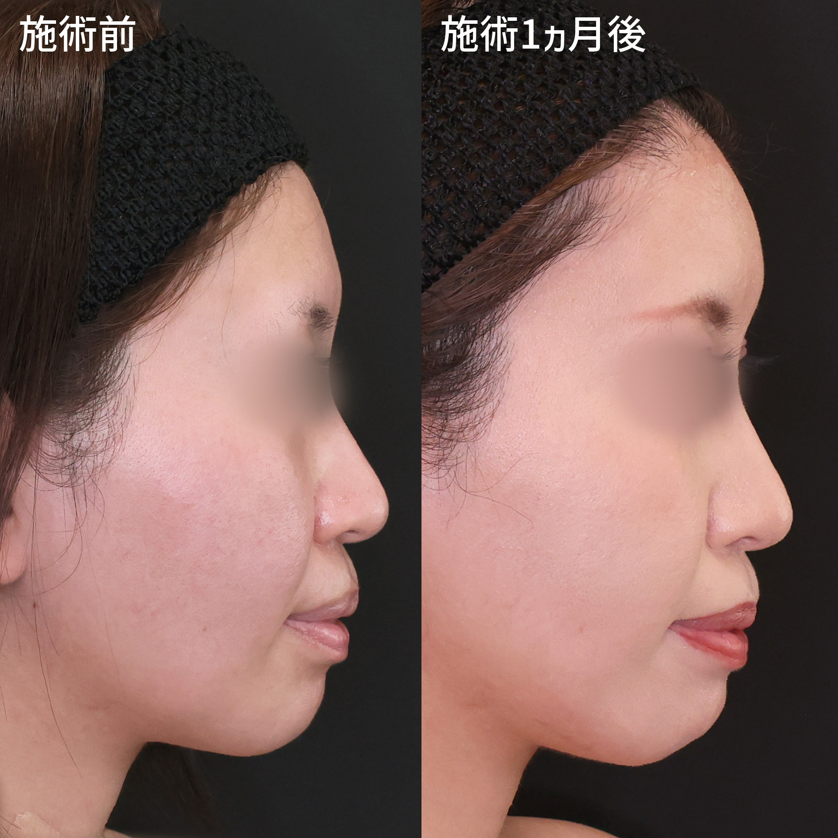 【額の脂肪注入】丸みのあるおでこで女性らしい輪郭に【糸リフト】