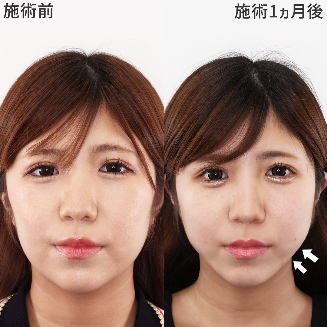 理想の卵型輪郭を手に入れる