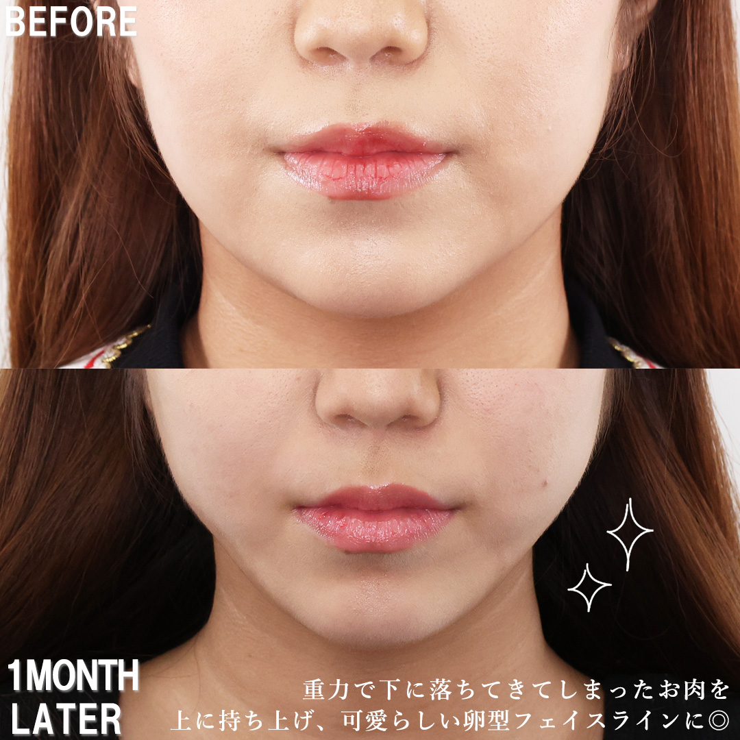 TAC式 ツヤ肌コラーゲンリフト®/涙袋形成(ヒアルロン酸注射)/エラボトックス注射の症例写真 施術前後 1ヵ月