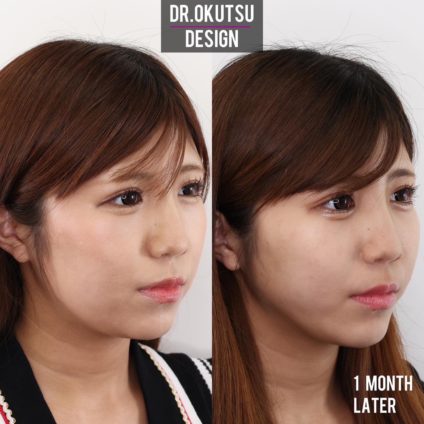 TAC式 ツヤ肌コラーゲンリフト®/涙袋形成(ヒアルロン酸注射)/エラボトックス注射の症例写真 施術前後 1ヵ月