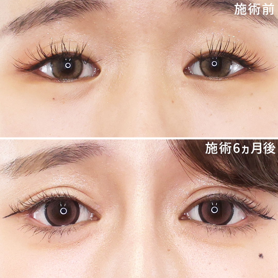 二重切開（全切開法）/目頭切開術/目尻切開術の症例写真 施術前後 