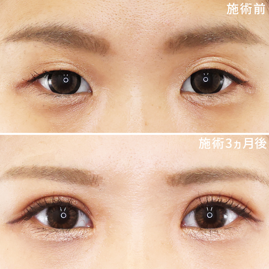 《切開法》たるみのある上瞼から理想のMIX型二重に