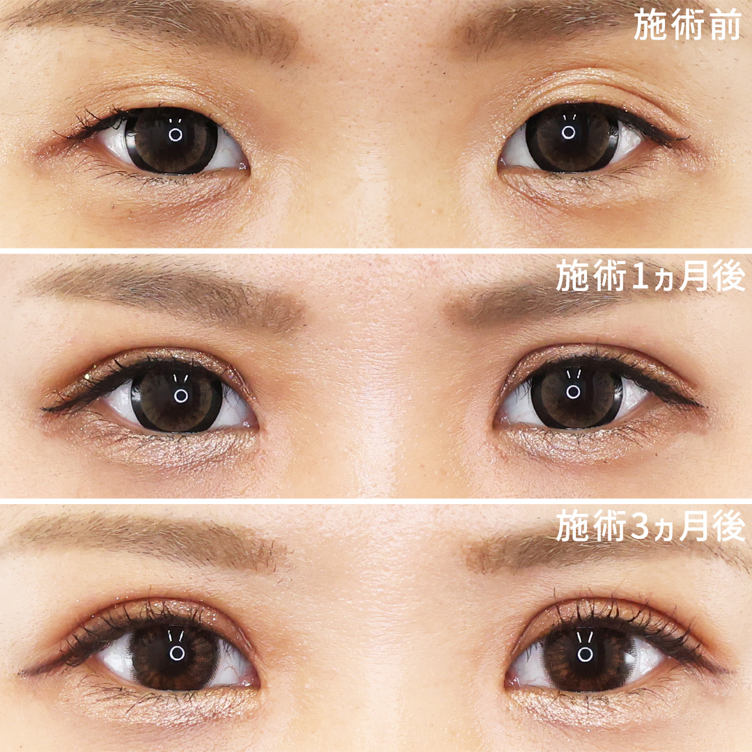 二重切開（全切開法）/目頭切開術の症例写真 施術前後 
