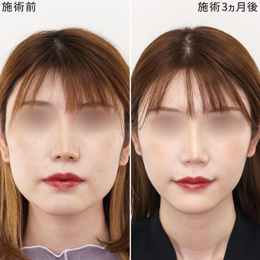 《小顔施術+口角挙上》で優しい印象に