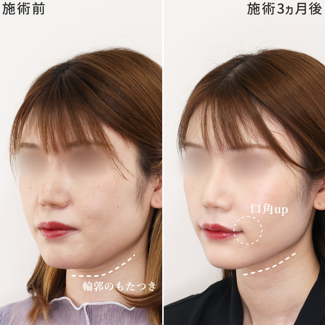 口角挙上・リフト（マイクロ切開法・内側法/口内法）/TAC式 ツヤ肌コラーゲンリフト®/エラボトックス注射の症例写真 施術前後 