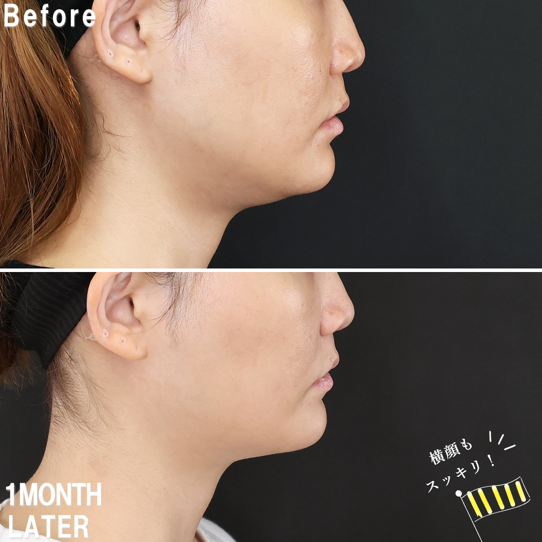 ジョールファット除去/TAC式 ツヤ肌コラーゲンリフト®/エラボトックス注射の症例写真 施術前後 