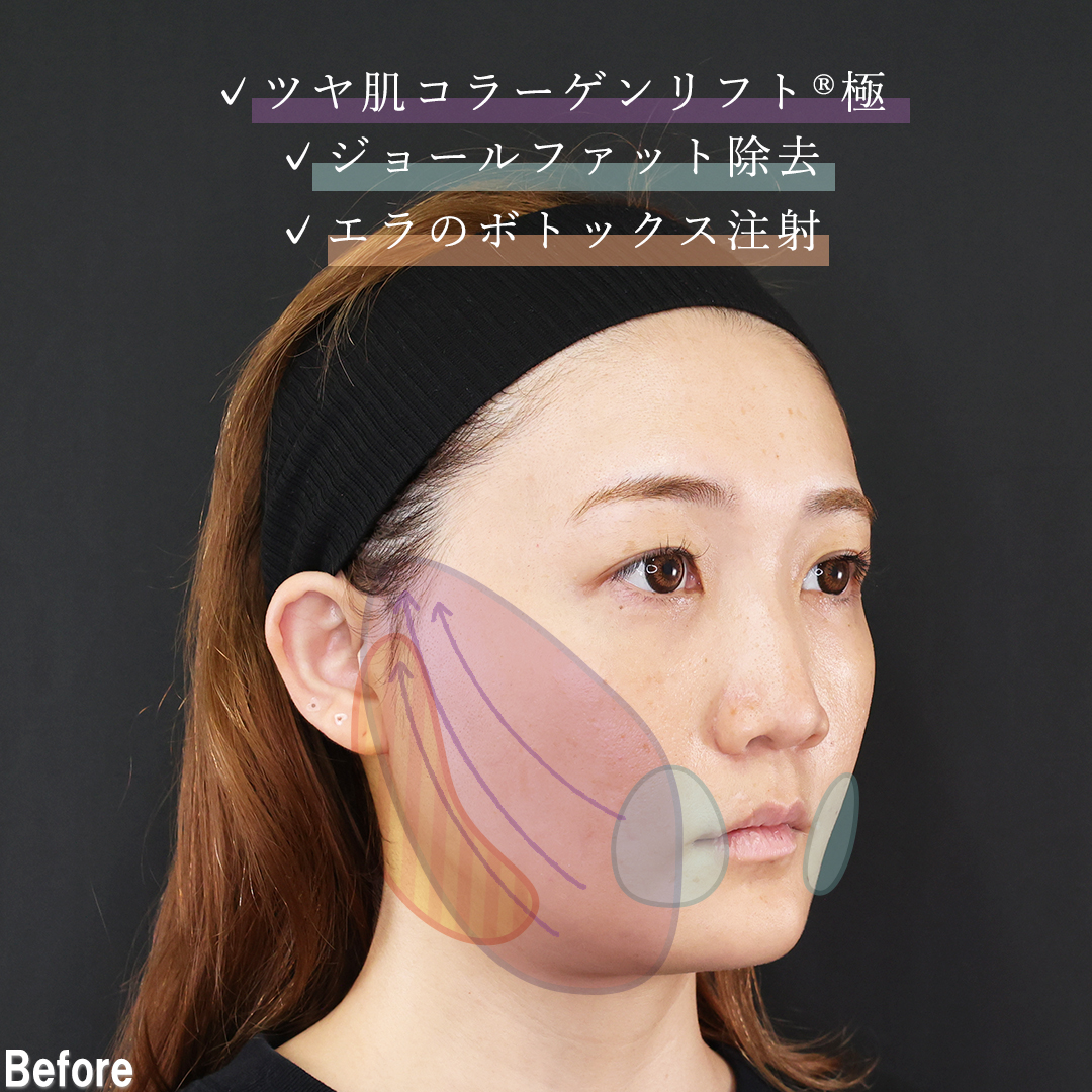 ジョールファット除去/TAC式 ツヤ肌コラーゲンリフト®/エラボトックス注射の症例写真 施術前後 